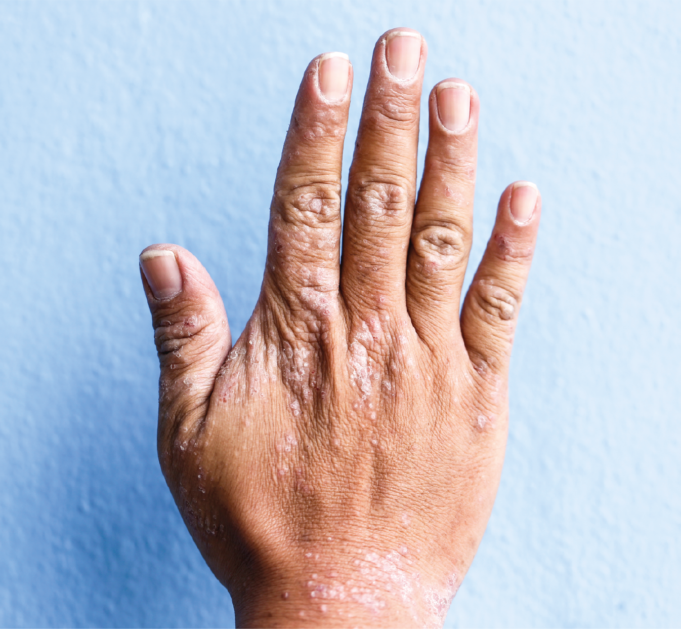 Eczema on hands