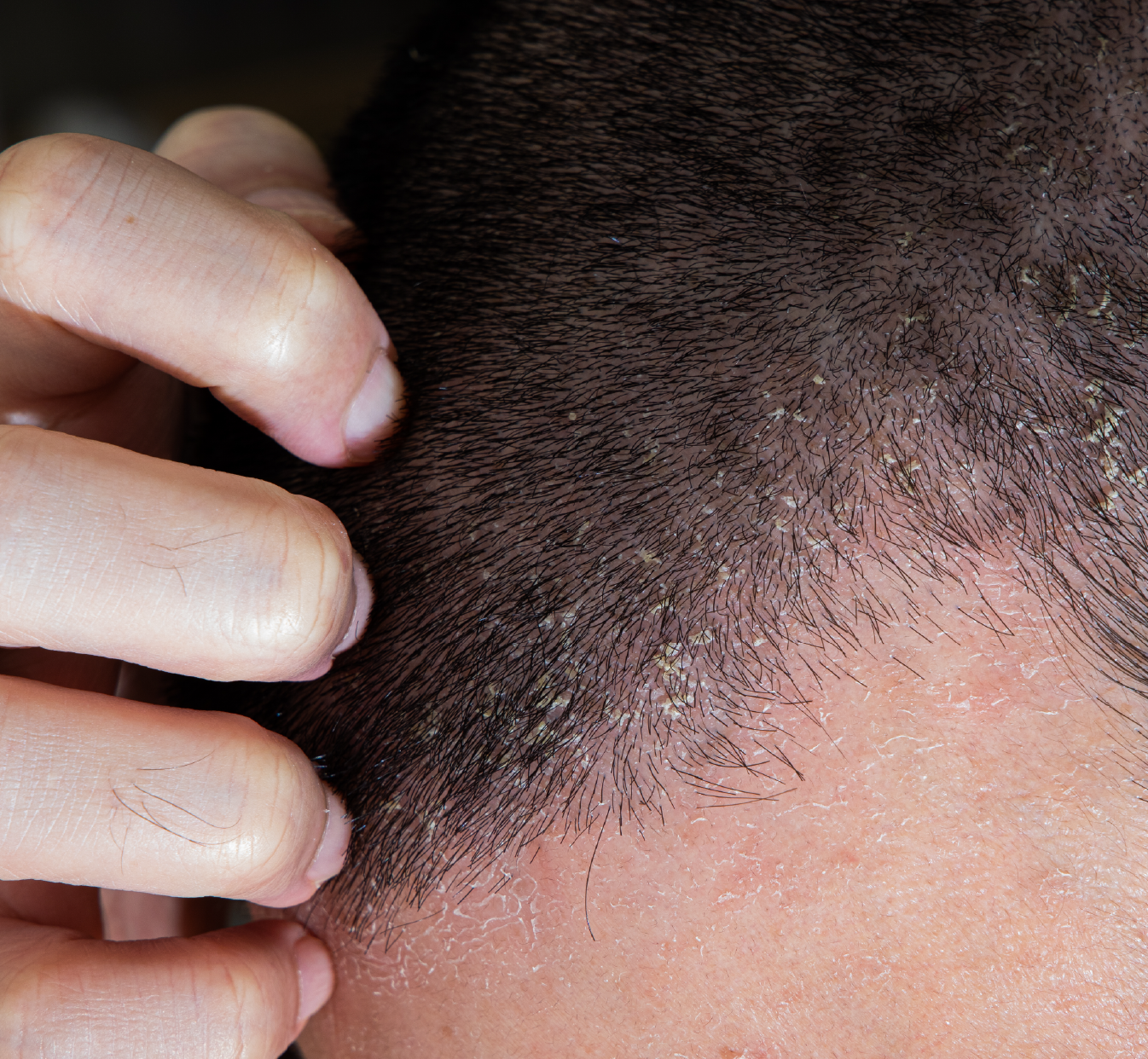 Man scratching scalp